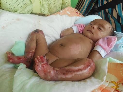 Alami Kelainan Kulit, Satu-Satu Anggota Tubuh Bayi Wasesa Lepas Dari Tubuhnya