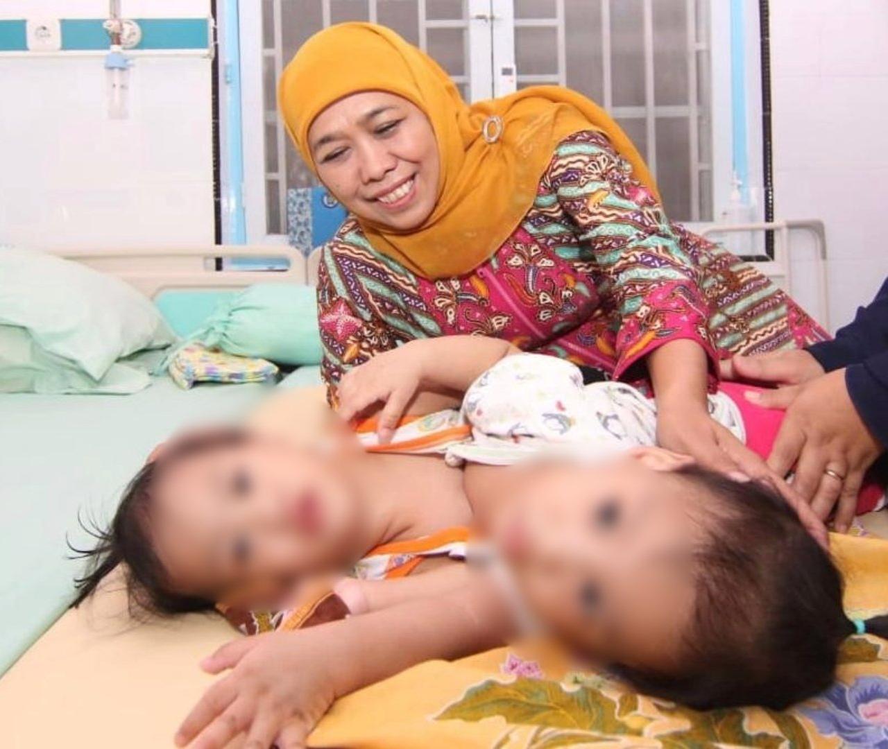 Akila dam Azila, Kembar Siam Ke 99 RSU Dr. Soetomo Akan Dioperasi