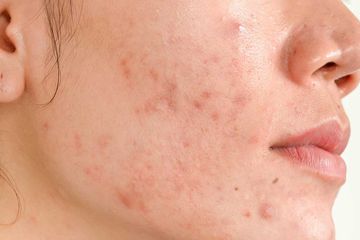 Waspada, Korban Skincare Palsu Alami Kerusakan Kulit